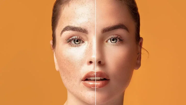 Pigmentfolt eltávolítás lézerrel és arckezelés Debrecen